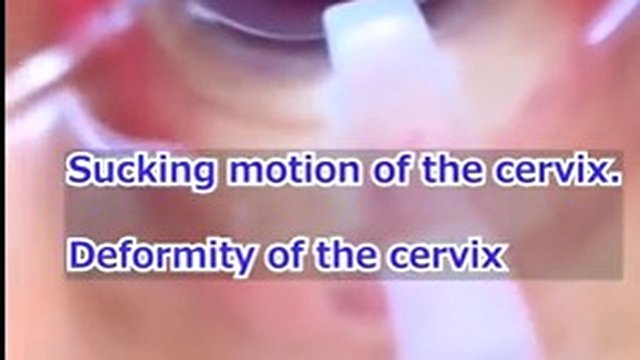 Vagina, cervix Rhythmically hit the orgasm vaginal endoscope with strong suction, squeezing and raising the spike.